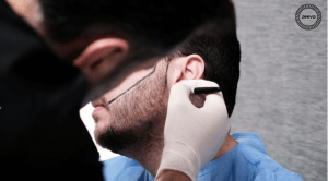 Beard Transplant Beard Transplant– What to Expect in the First 10 Days