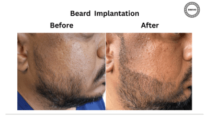 Beard Transplants in Ahmedabad Beard Transplant– What to Expect in the First 10 Days