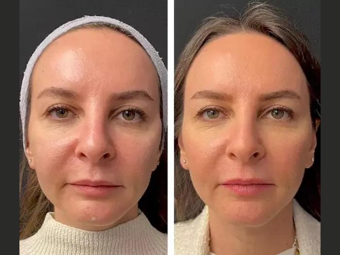 What Makes the Best Doctors in Dubai for Mesotherapy Stand Out from the Rest?